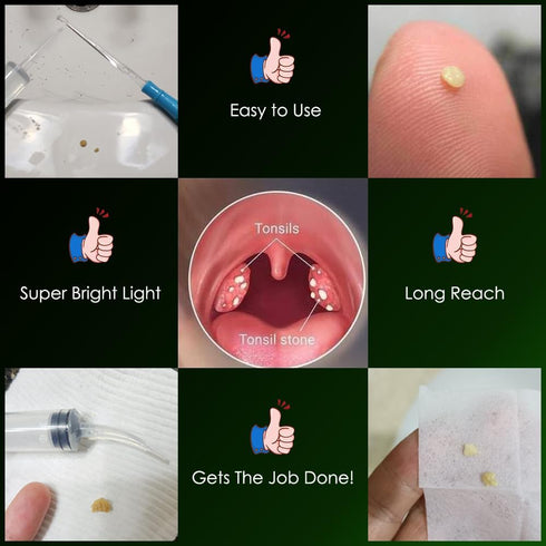 Airgoesin Upgraded Tonsil Stone Remove Tool + Irrigation Clean Syringe for Fresh Breath