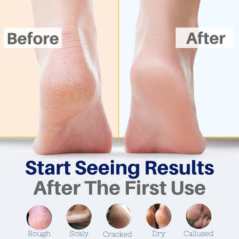 Yellow Bird Natural Foot Cream, Organic Athlete’s Foot Balm, Moisturizer for Heel Care & Callus Treatment