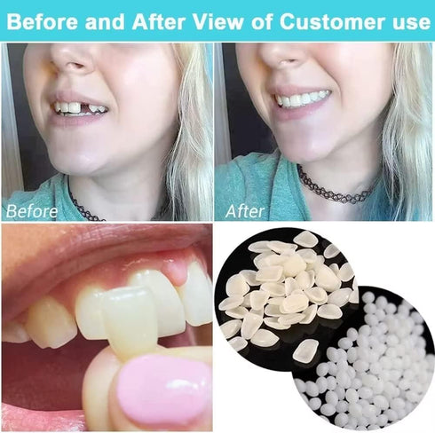 Fake Tooth Repair Kits for Filling Missing Broken Tooth and Gaps, Moldable Fake Teeth and Thermal Beads Replacement Kits