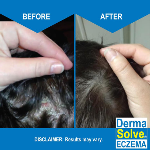 Pack) Eczema Shampoo & Conditioner (Combo - Flare Control Scalp & flake Relief Therapy that Protects, Moisturizes