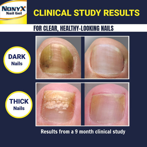 Nail Clarifying Gel, Clinically Proven for Discolored and Damaged Toenails, Effective Treatment