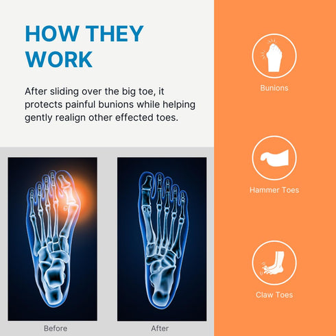 Gel Big Toe Bunion Guards & Toe Spreaders by NatraCure (2 Pieces) - Pain Relief for Crooked Toes