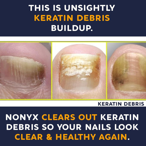 Nail Clarifying Gel, Clinically Proven for Discolored and Damaged Toenails, Effective Treatment