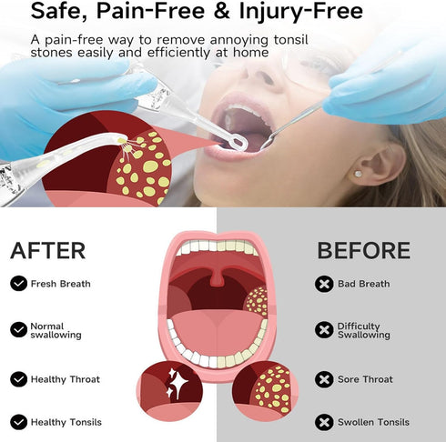 IINCOOY 3 Tonsil Stone Remover Kit Electronic Vacuum Oral Care Mouth Cleaner with Suction Modes Instant Suction Tools