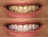 ProDental Teeth Whitening Gel Syringe Refill - 10 Pack, 35% Carbamide Peroxide for Faster Results