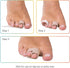 Hammer Hammertoe 4 Count ZenToes Toe Corrector for Women & Men - Reusable Fabric Buddy Wraps for Broken Toes