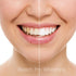 Teeth Whitening Gel Syringe Dispensers, 22% Carbamide Peroxide, 10 Tooth Bleaching Gel 3ml Syringes
