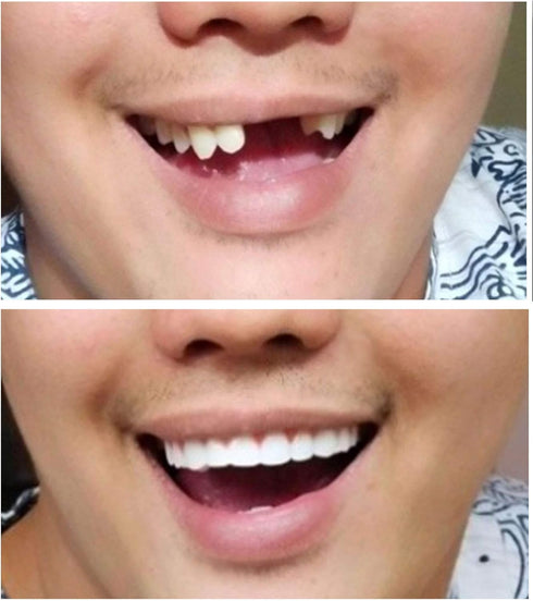Instant Smile Comfort Fit Flexible Lower Teeth