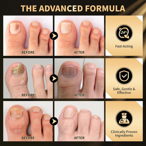Toenail Fungus Treatment Extra Strength Pen for Damaged Toenail & Finger, More Pure Natural Plant Extracts, Toe Nail