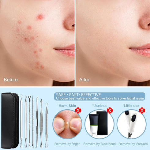 Teenitor 7 in 1 Pimple Popper Tool Kit, Blackhead Remover, Pimple Extractor, Comedone Extractor for Face
