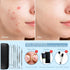 Teenitor 7 in 1 Pimple Popper Tool Kit, Blackhead Remover, Pimple Extractor, Comedone Extractor for Face