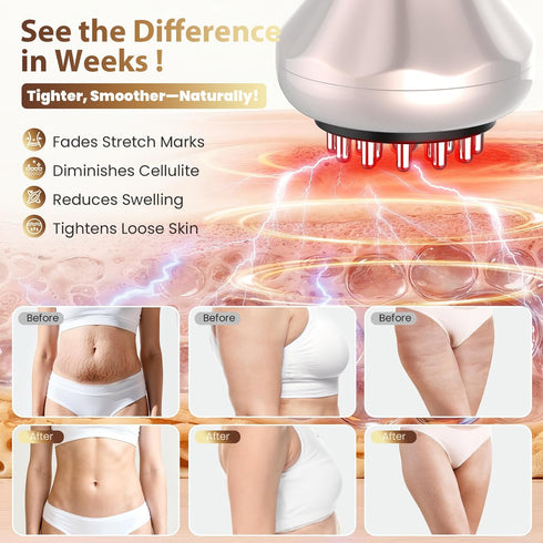 nanagoo Lymphatic Drainage Massager, Anti Cellulite Massage Tool For Belly & Thigh Stretch Marks & Cellulite Reduction