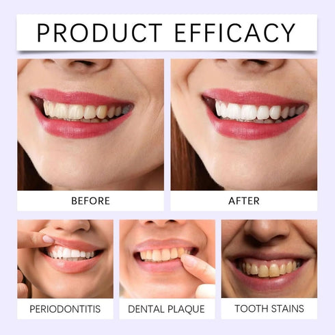 Longfng 3-in-1 3X 7pcs Teeth Whitening Kit,LED Accelerator Light with Whitening Gel Pens & Shine Whitening Strips