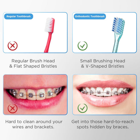 V-Shaped Orthodontic Toothbrush for Braces, Soft Bristles, 6 Count, No Interdental Brushes Included