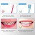V-Shaped Orthodontic Toothbrush for Braces, Soft Bristles, 6 Count, No Interdental Brushes Included