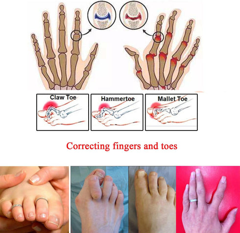 8 Pieces Toe Splint Wraps, Non Slip Hammer Toe Straightener for Broken, Crooked, Overlapped Toes - Women and Men