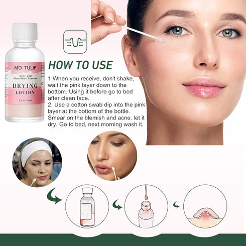 MO TULIP Acne Drying Lotion - Overnight Acne Spot Treatment for Face and Body, 1OZ Pimple Lotion