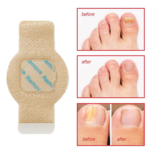 ISUNRISE 21 8-Hour Nail Repair Patches Pcs, Toenail Treatment Extra Strength, Overnight Nail Treatment for Damaged