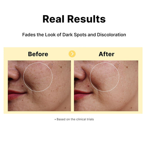 5% Tranexamic Acid Serum with 5% Niacinamide, Dark Spot Correcting Serum for Hyperpigmentation, 1Fl Oz