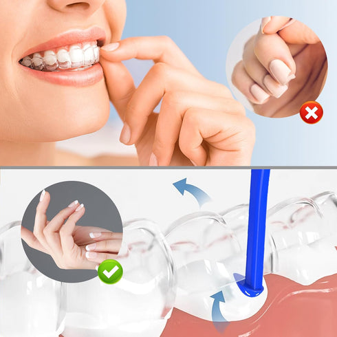 Aligner Removal Tool, 5 Invisible Braces Removal Tools for Dentures, Trays, Retainers, and Aligners (Dark Blue)
