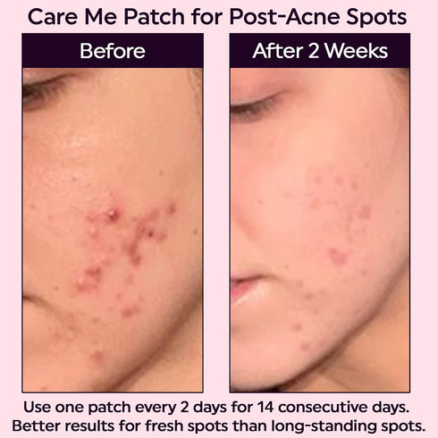Micropoints for Acne Dark Spot Treatment, 127 Mircropoints Post-Blemish Dark Spots Removal Patch (9 count/pack)