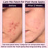 Micropoints for Acne Dark Spot Treatment, 127 Mircropoints Post-Blemish Dark Spots Removal Patch (9 count/pack)