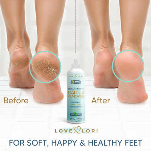 Callus Remover for Feet, Extra Strength Foot Callus Remover Gel, 6oz