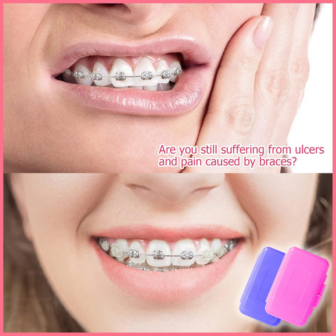 Wax for Braces Dental Care Orthodontic Wax for Retainer Brace Wearers, Safe Food Grade Wax(6 Pcs)