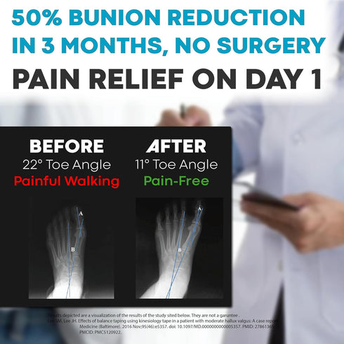 Bunion Correction & Pain Relief Tape, 40 Count, Precut Kinesiology Tape for Bunions, Big Toe Sprains, Pain Relief and