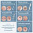 JPNK Blackhead Remover Comedone Extractor, Acne Removal Kit.