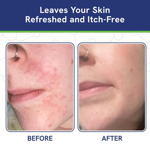 pHat 5.5 Seborrheic Dermatitis Moisturizing Cream & Face Lotion for Women, 8oz