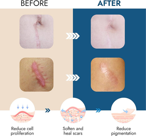 Scarbandit Silicone Scar Sheets - Treatment for Keloid, Tummy Tuck, Burns, Hypertrophic & Surgical Scars