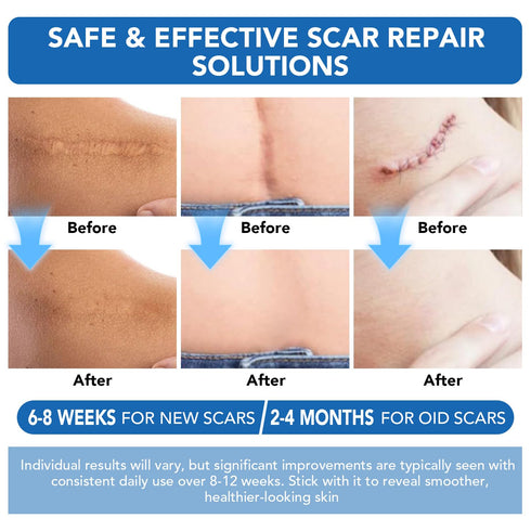 Niifawh Tape(1.6"x 120" Roll-3M) Clear Silicone Scar Sheets, Silicone Scar - Reusable, Soft & Medical Grade Adhesive