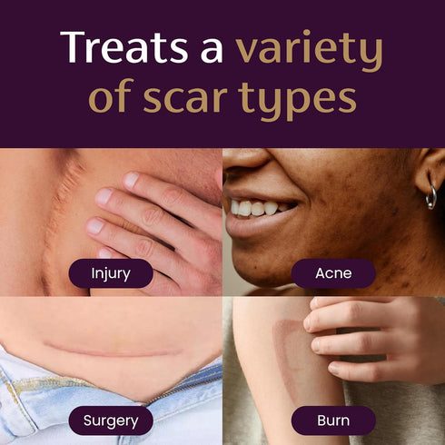 Mederma Scar Cream Plus SPF 30 - Advanced Treatment for Scars from Acne, Burns, Surgery & Injury
