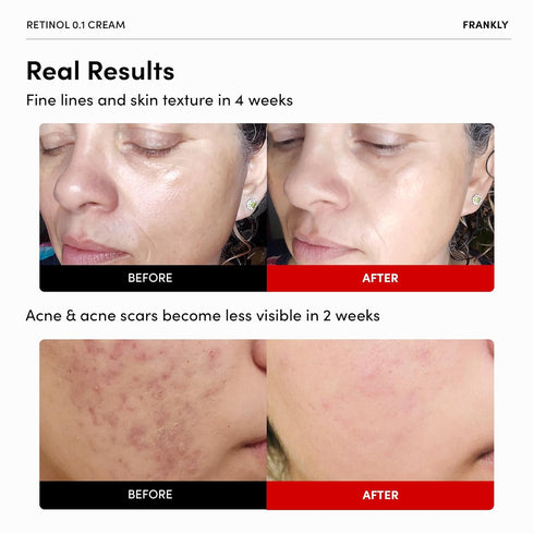 FRANKLY Retinol 0.1 Cream | Beginner Retinol for Anti-Aging, Skin Lifting & Restoration | Night Cream, 1.01 fl. oz.