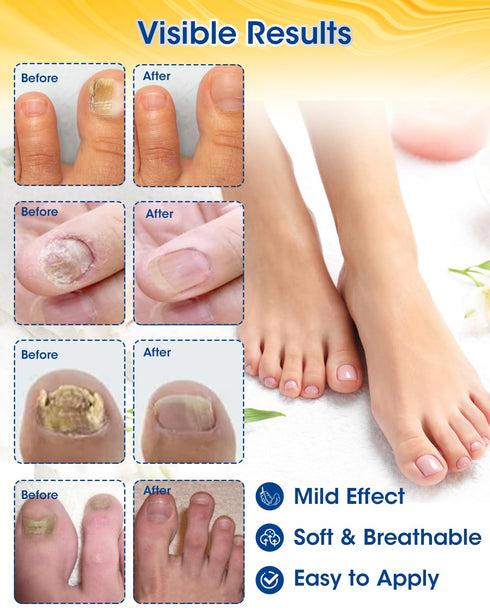 Nail Repair Patches Extra Strength, 28 Count for Damaged Nails, Nighttime Renewal Patches