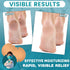 TEAWOO 30PCS (80mm 80mm) Patented Cracked Heel Treatment Patches, Cracked Heel Repair Bandage x