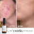 Hydrating Face Serum for Clearing Acne & Scars, Anti-Blemish & Scar Repair Serum for All Skin Types (1.01 oz)