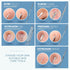 Teenitor 7 in 1 Pimple Popper Tool Kit, Blackhead Remover, Pimple Extractor, Comedone Extractor for Face
