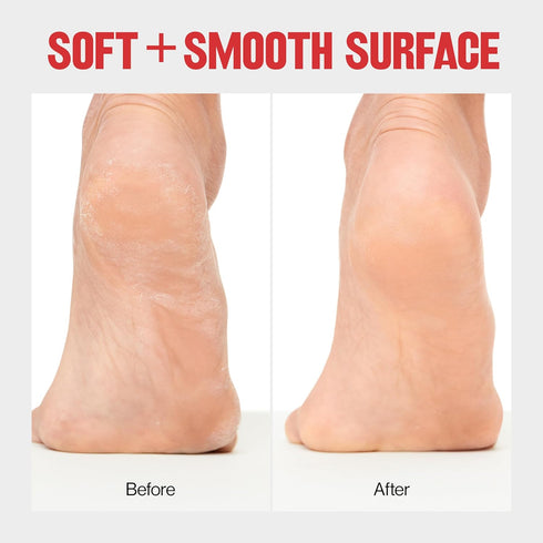 Revlon Callus Remover, Foot File for Wet or Dry Skin, Easy to Use Pedicure Tool (Pack of 1)