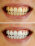 Teeth Whitening Gel Syringe Dispensers, 22% Carbamide Peroxide, 10 Tooth Bleaching Gel 3ml Syringes