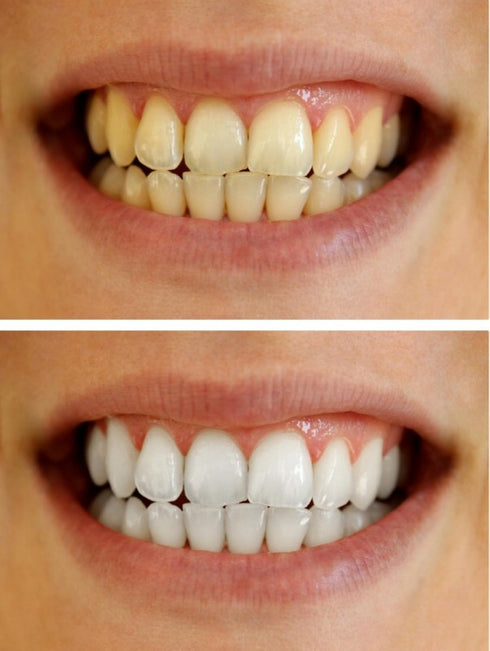 Teeth Whitening Gel Syringe Dispensers - 22% Carbamide Peroxide Tooth Bleaching Products, 10ml, 4 Pcs