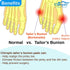 Chiroplax Bunion Corrector Pads, 4 Regular Size Silicone Cushions for Bunionette Pain Relief, Men & Women