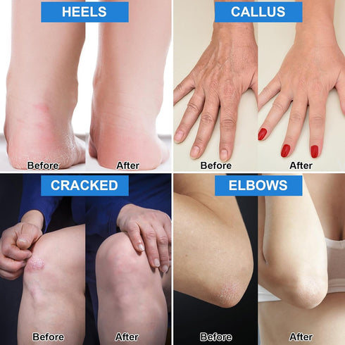 Urea Cream 42% Plus Salicylic Acid 2%, 2 Pack, Foot Care Moisturizer for Cracked Heels