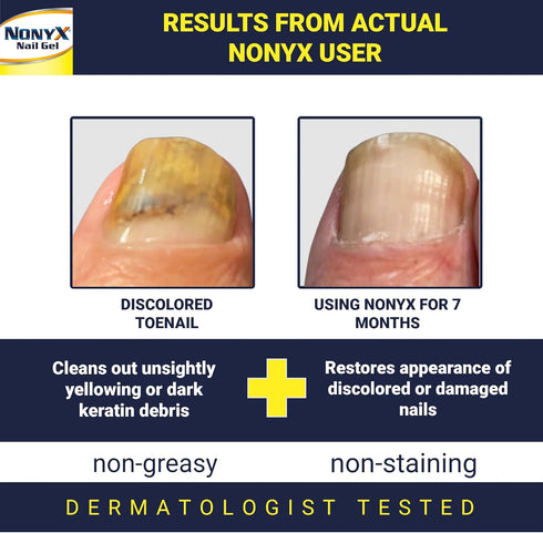 Nail Clarifying Gel, Clinically Proven for Discolored and Damaged Toenails, Effective Treatment