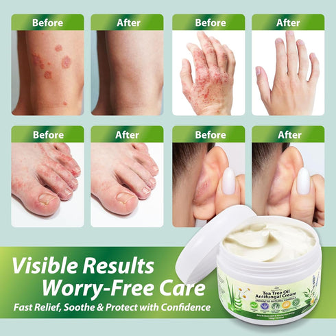 Recuren Plus 100g Antifungal Cream with Tea Tree Oil Advanced Herbal Relief for Skin Fungus, Jock Itch, Eczema