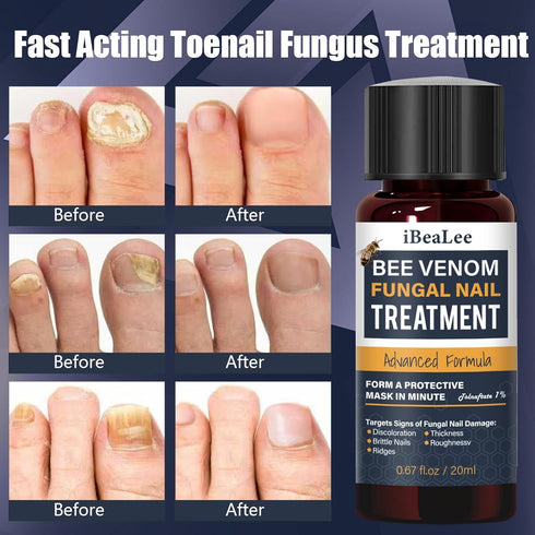 KISMIGER -1% 2 Toenail Fungus Treatment Extra Strength Tolnaftate, Bee Venom Nail Fungus Treatment, Gentle Fungal Nail