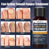 KISMIGER -1% 2 Toenail Fungus Treatment Extra Strength Tolnaftate, Bee Venom Nail Fungus Treatment, Gentle Fungal Nail