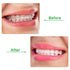 10 Pieces Aligner Trays Seater for Aligner Chompers Orthodontic Dental Aligner (Green)