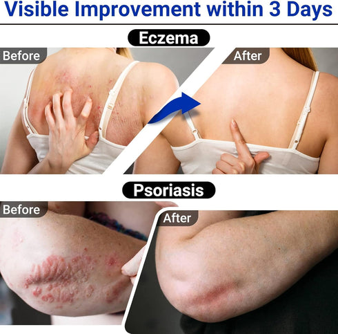 Eczema Cream, Maximum Strength Treatment Ointment for Rash, Psoriasis, Dermatitis, Anti-Itch Relief for Sensitive Skin